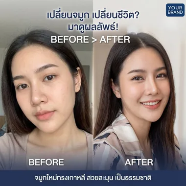 เปลี่ยนจมูก ก่อน-หลัง